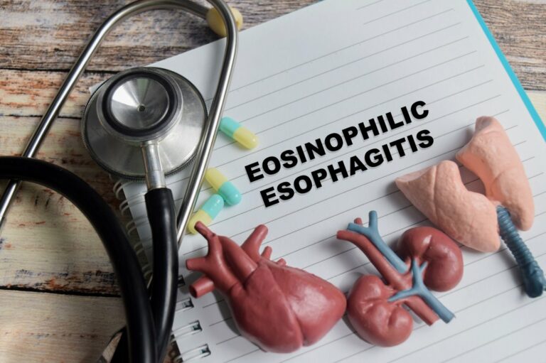 Key factors to know about eosinophilic esophagitis