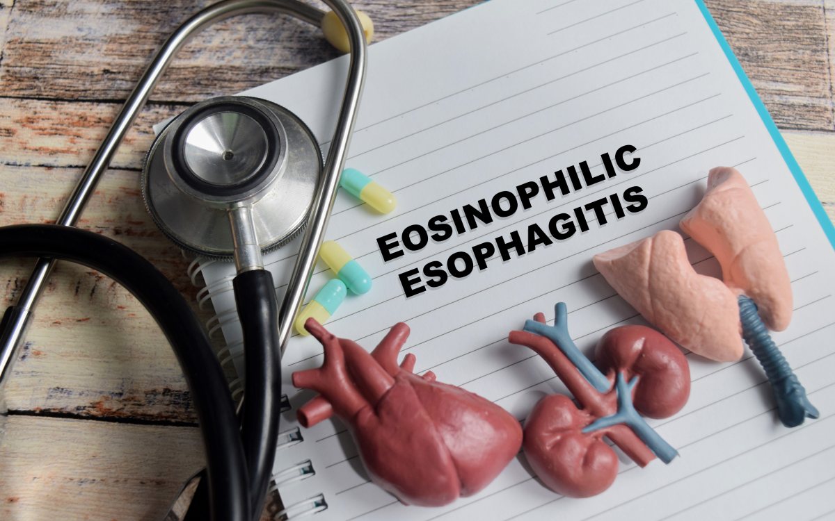 Key factors to know about eosinophilic esophagitis