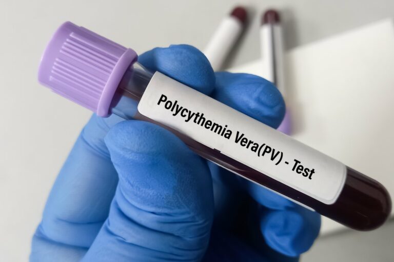 Polycythemia vera – Symptoms and risk factors
