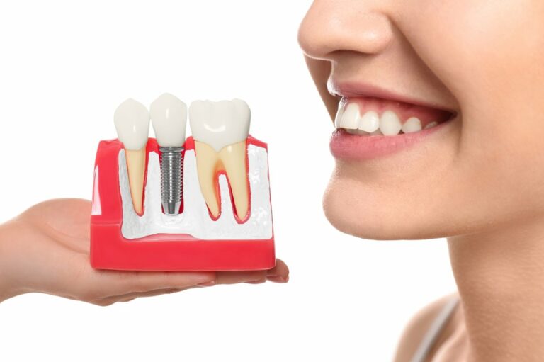 Ways to find affordable dental implants